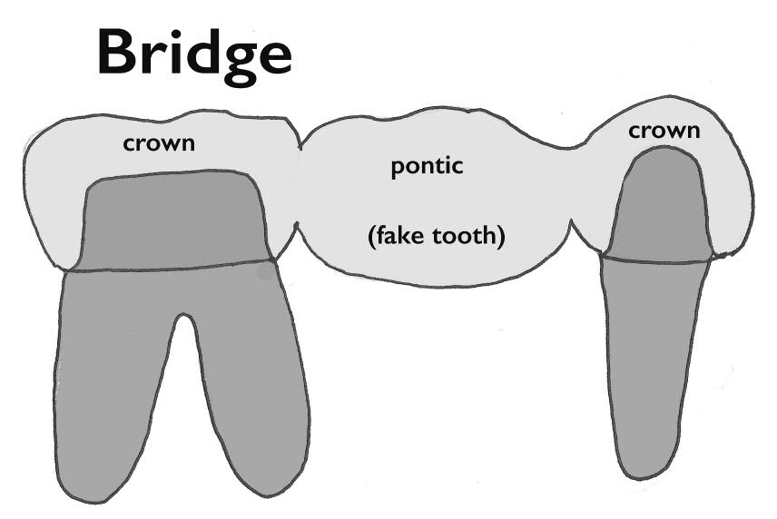 dental bridge