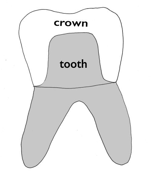 dental crown